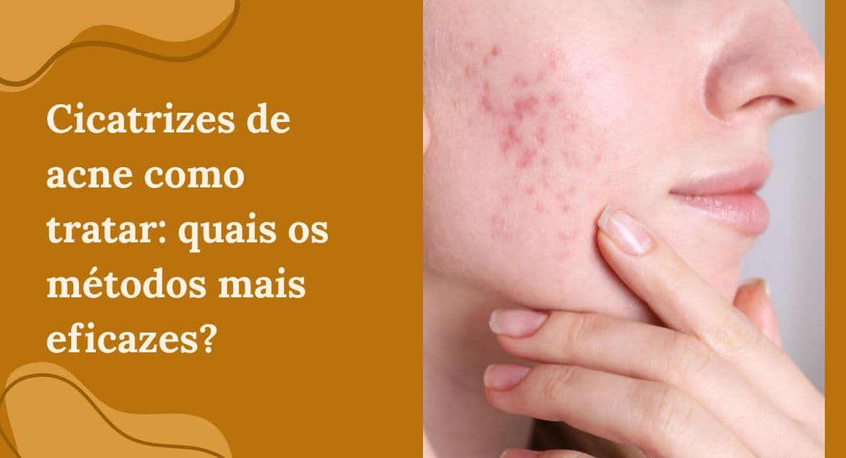 Cicatrizes de Acne: Como Tratar e os Métodos Mais Eficazes da Estética