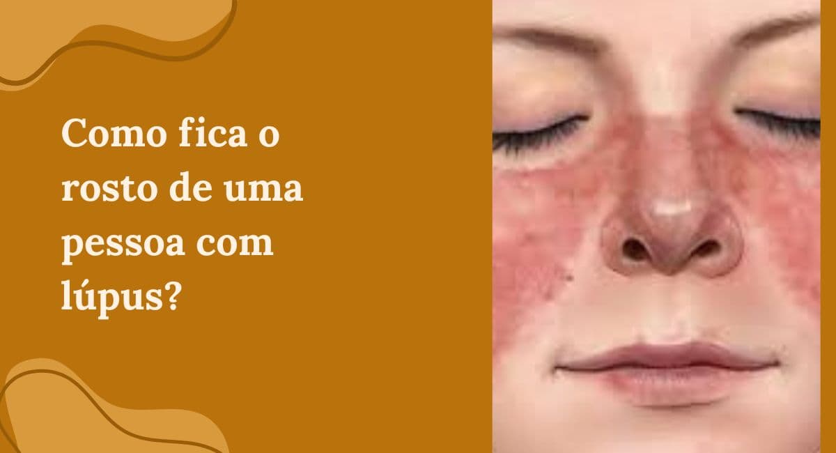 Como fica o rosto de uma pessoa com Lúpus?