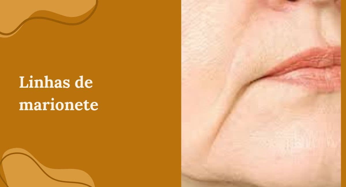 Linhas de Marionete: O Que São, Por Que Aparecem e Como Tratá-las