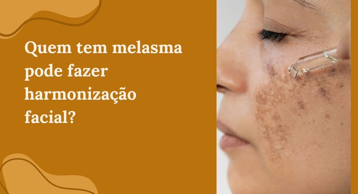 Quem tem Melasma pode fazer Harmonização Facial? Mitos e Verdades