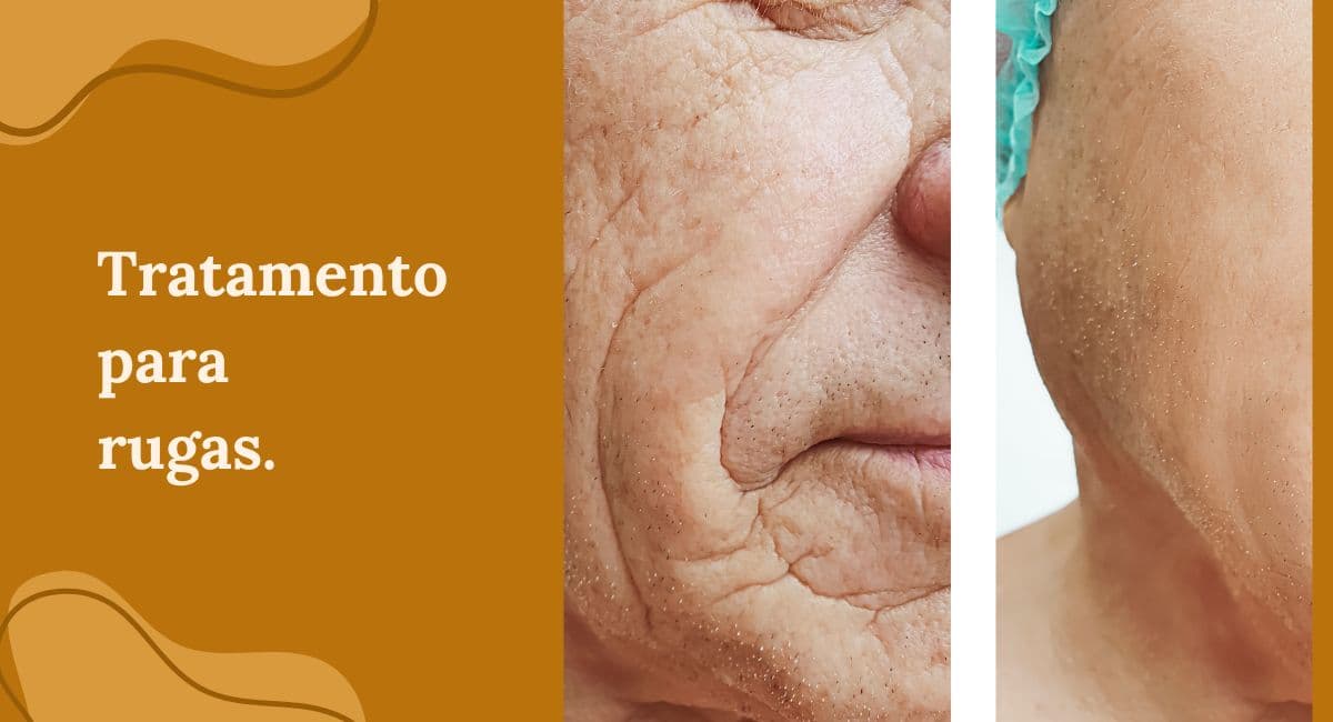 Tratamento para Rugas: O Guia Definitivo da Prevenção à Restauração